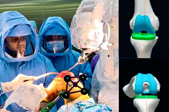Robotic Knee Replacement
